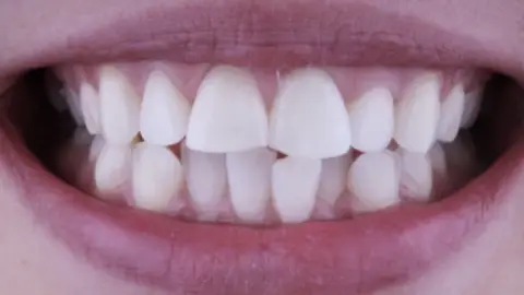 Teeth Whitening after treatment, case 3