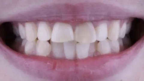 Teeth Whitening before treatment, case 3