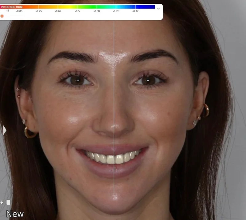 Digital smile design planning image showing the patient's proposed smile