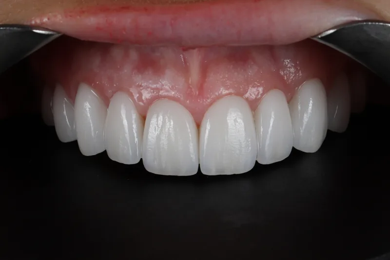 Clinical close-up of the patient's completed upper veneers