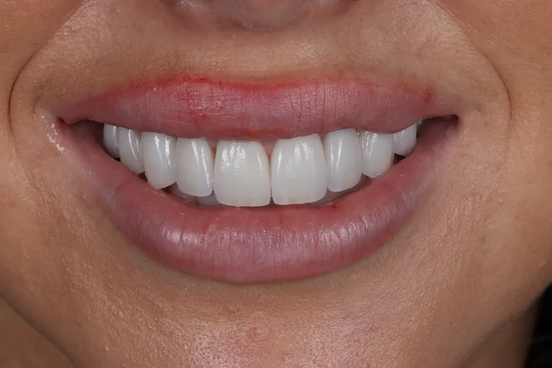 Patient smiling with completed veneers after treatment at Vitruvian Dental Studio