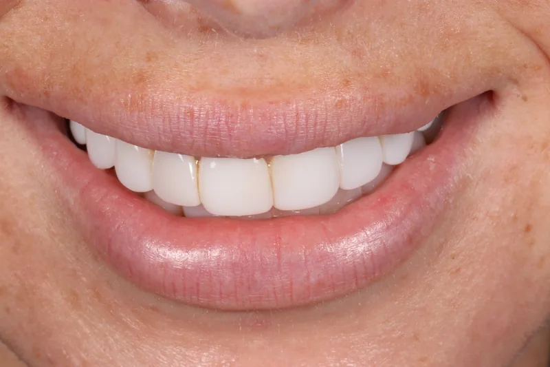 Patient's original composite bonding before veneer treatment at Vitruvian Dental Studio