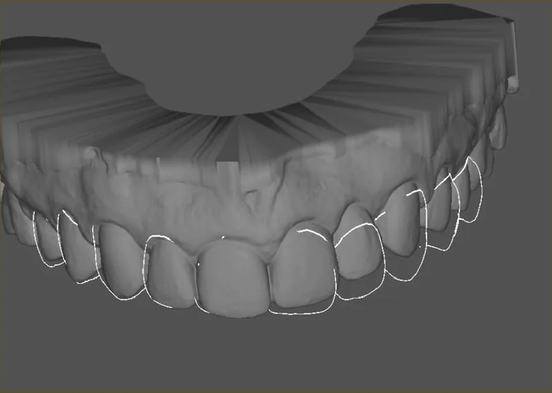 Three-dimensional dental scan render with outlines of the proposed veneer shapes