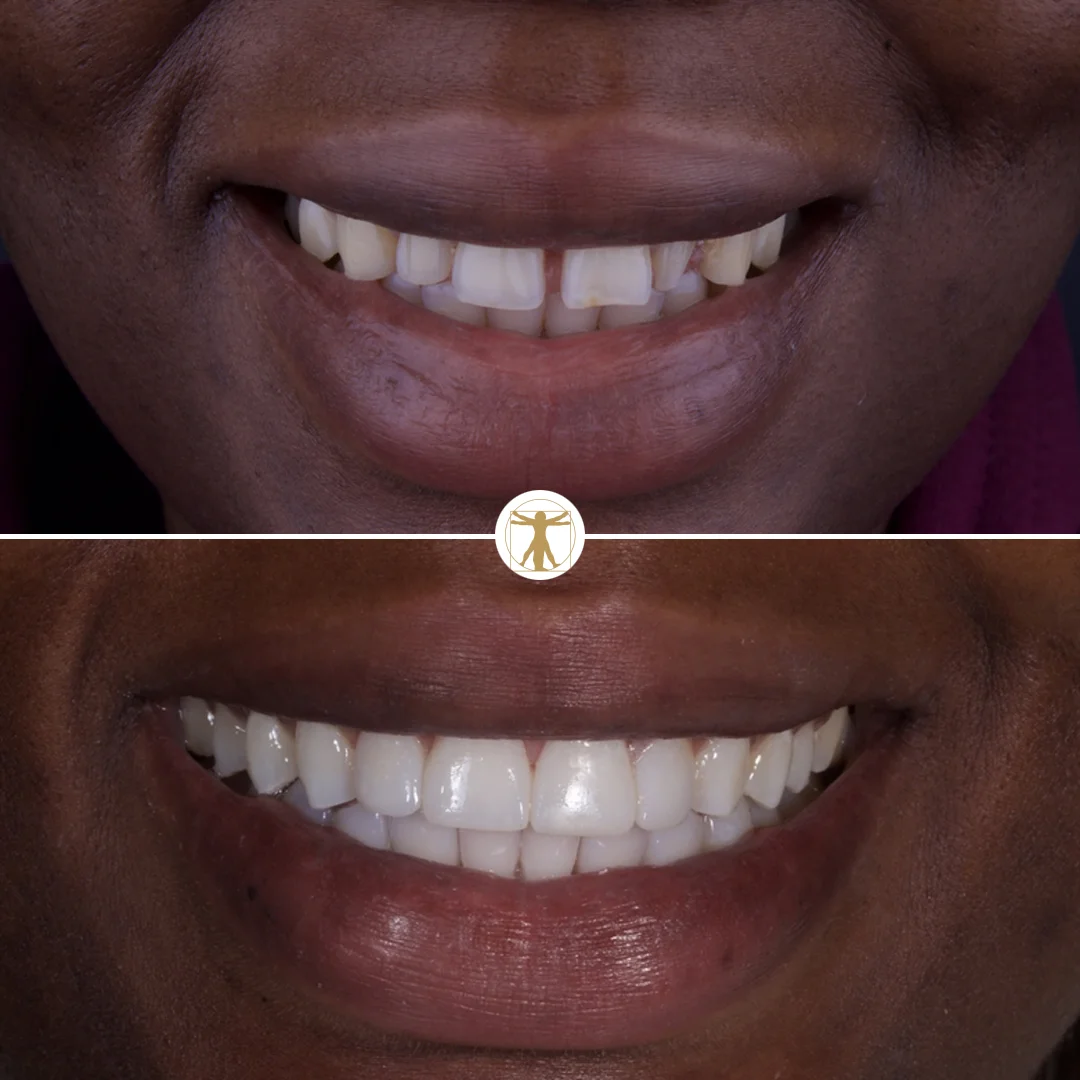 http://Straighten%20Your%20Teethbr/%20h3%20class=text-white%20display-3Invisalign/h3