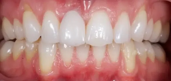 Dental implant after treatment