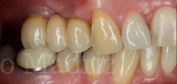 Dental implant after treatment