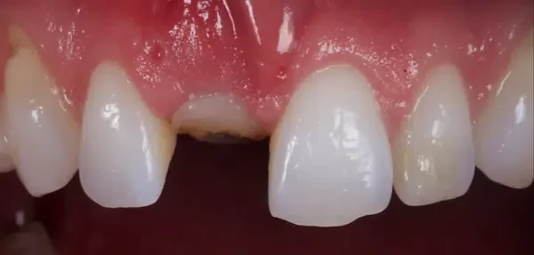 Dental implant before treatment