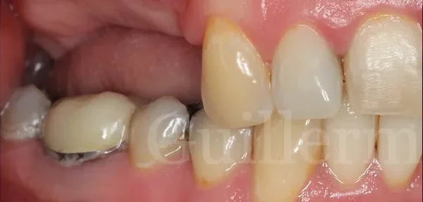 Dental implant before treatment