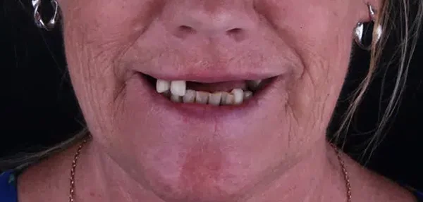 Dental implant before treatment