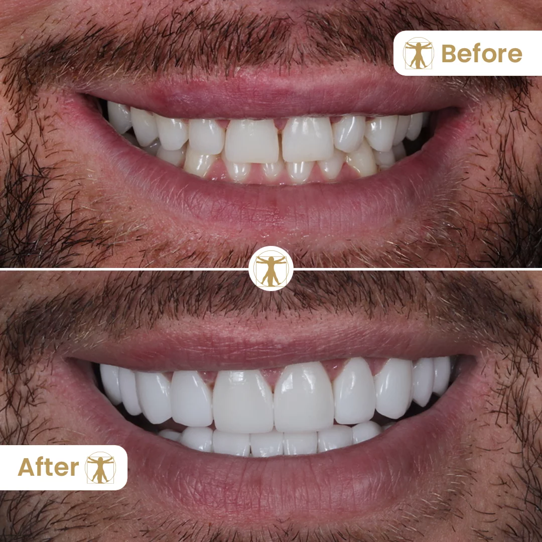 Composite veneers offer