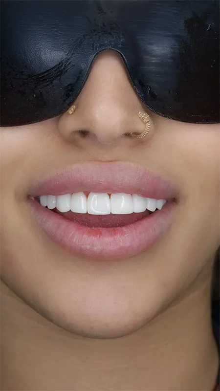 Hollywood Smile
<span class="brand-text">eMax Veneers</span>