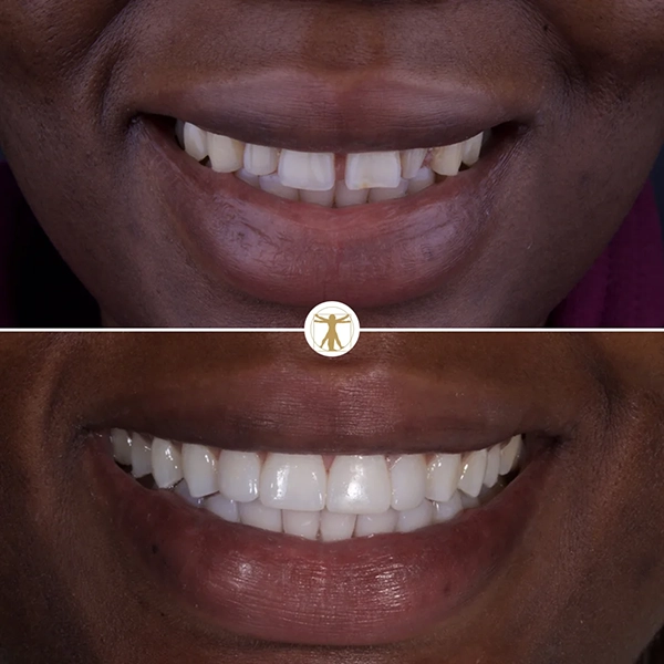 http://Straighten%20Your%20Teethbr/%20h3%20class=text-white%20display-3Invisalign/h3