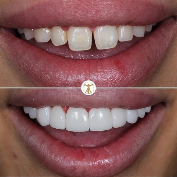http://Hollywood%20Smile%20Makeoverbr/h3%20class=text-whitePorcelain%20Veneers/h3