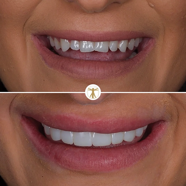 http://Same-day%20Smile%20Transformationbr/h3%20class=text-white%20display-4Composite%20Bonding/h3