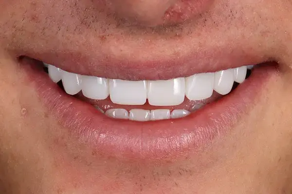 Veneers smile transformation placeholder