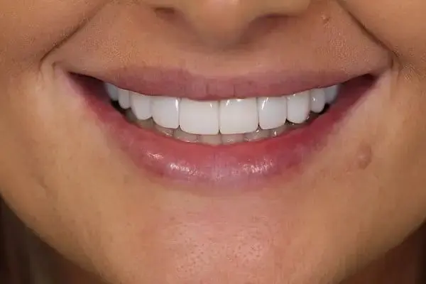 Composite bonding before and after placeholder