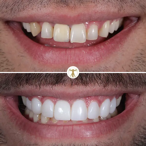 http://Hollywood%20Smile%20Makeoverbr/h3%20class=text-whitePorcelain%20Veneers/h3