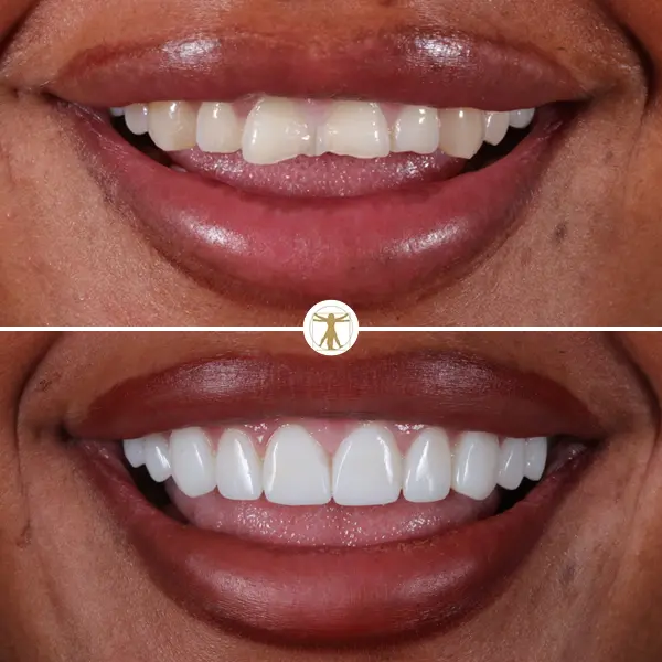 http://Same-day%20Smile%20Transformationbr/h3%20class=text-white%20display-4Composite%20Bonding/h3