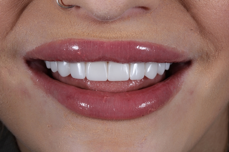 Composite bonding after treatment