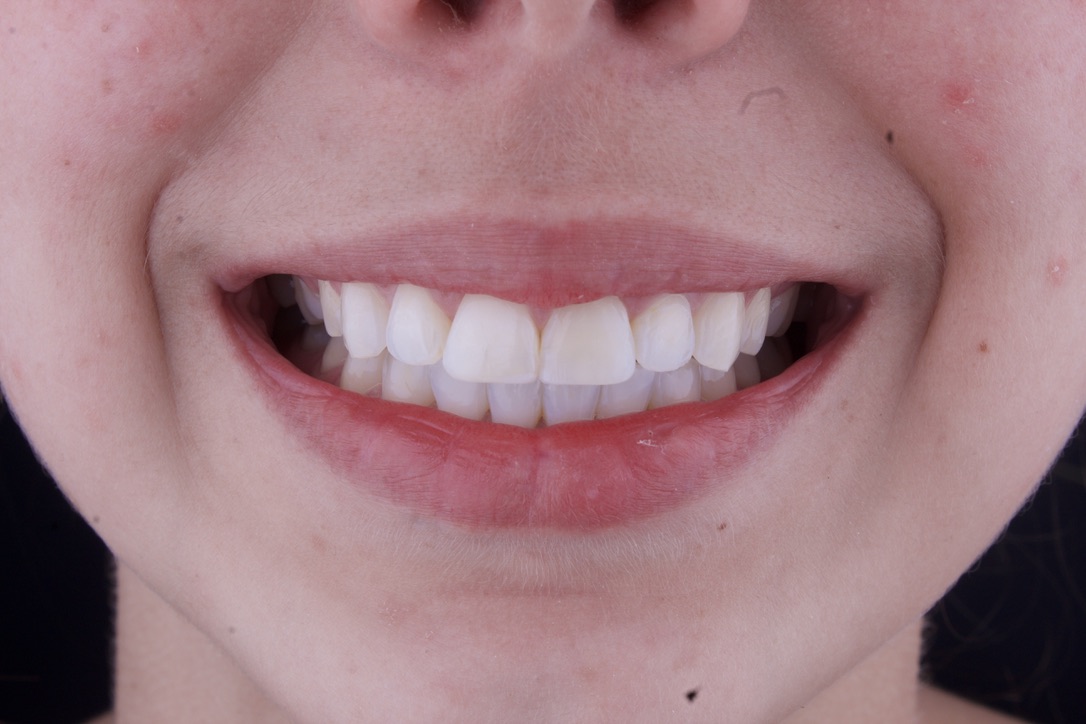 Teeth whitening before treatment