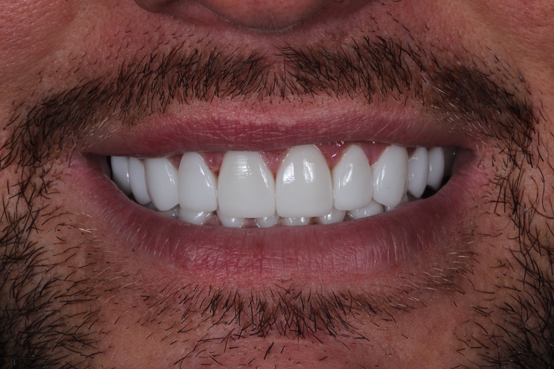 Veneers patient after smile transformation