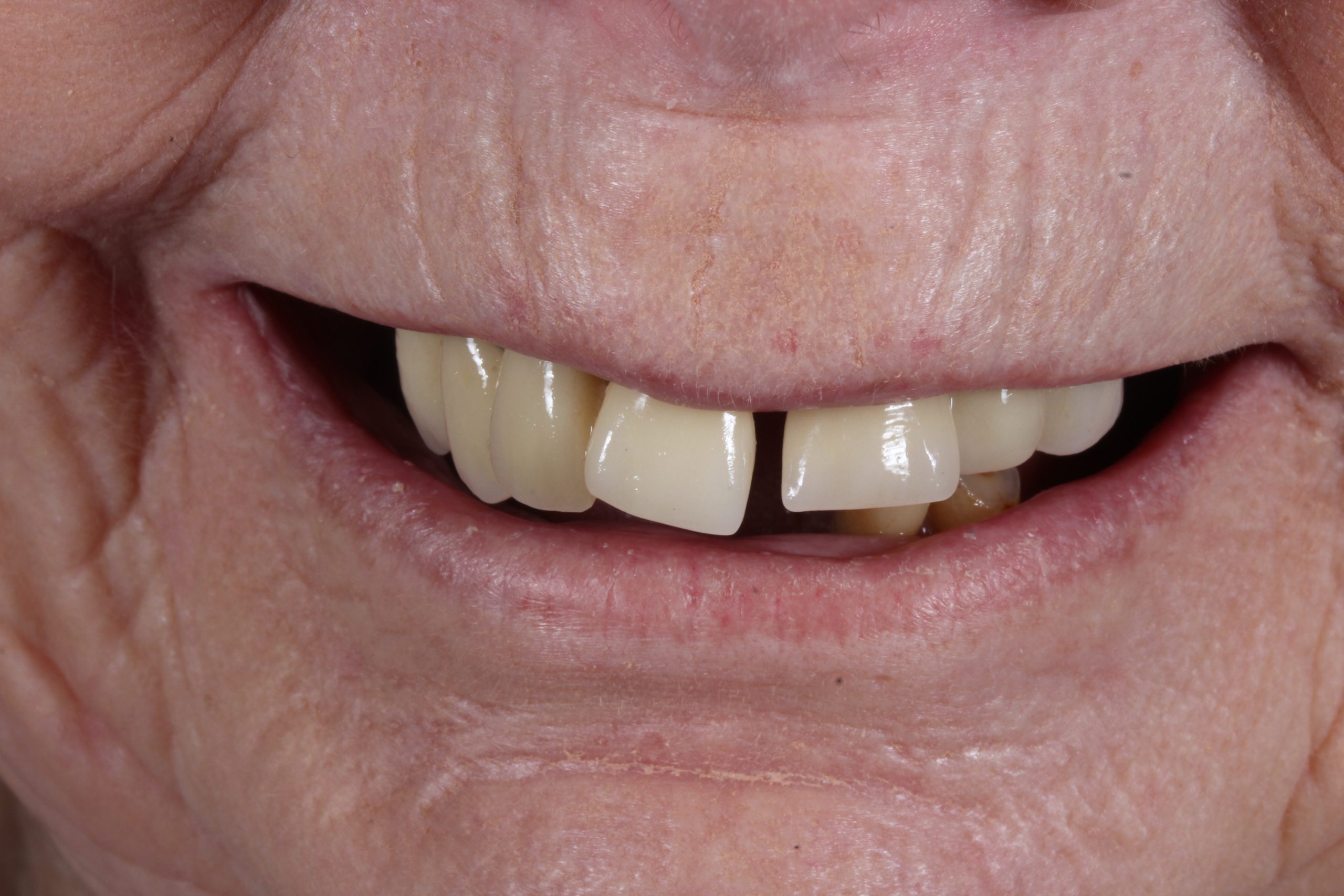 Dental implant before treatment