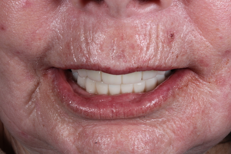 Dental implant patient with fixed teeth