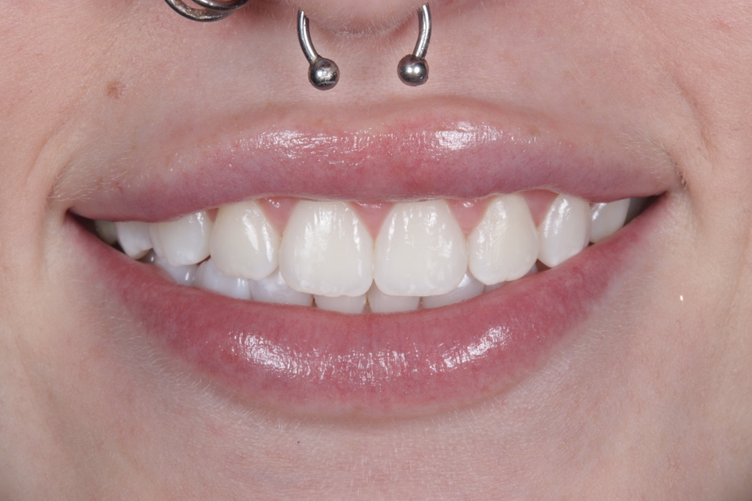 Invisalign after treatment