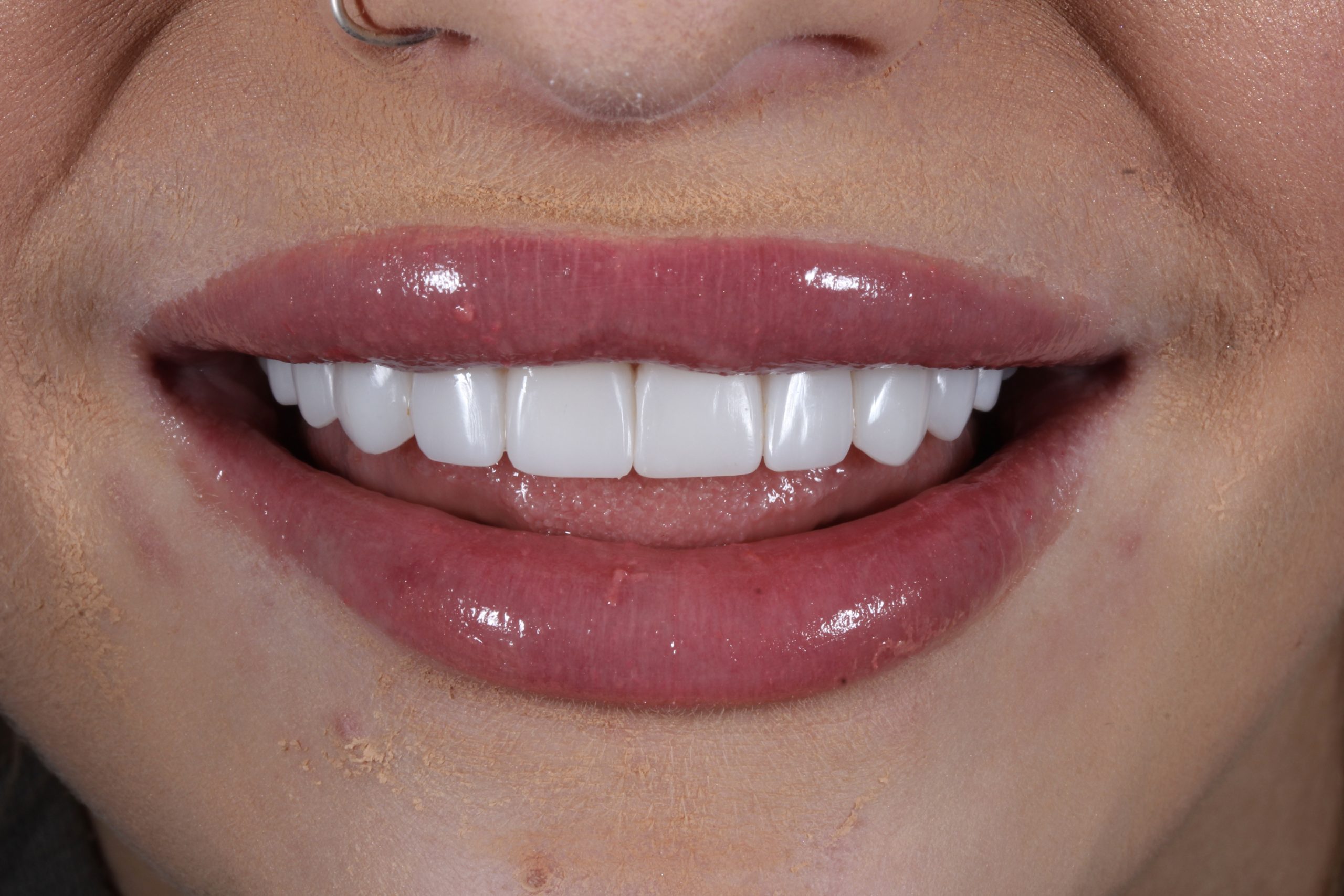 Composite bonding patient during smile makeover