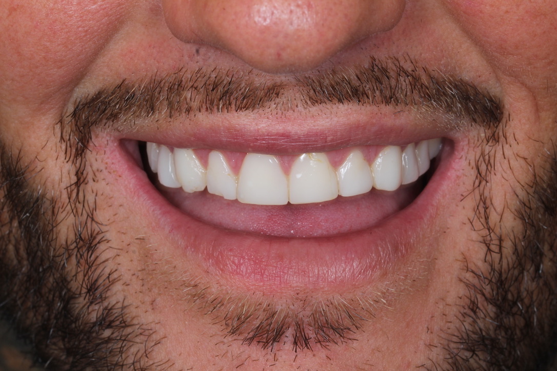 Veneers patient during smile design treatment