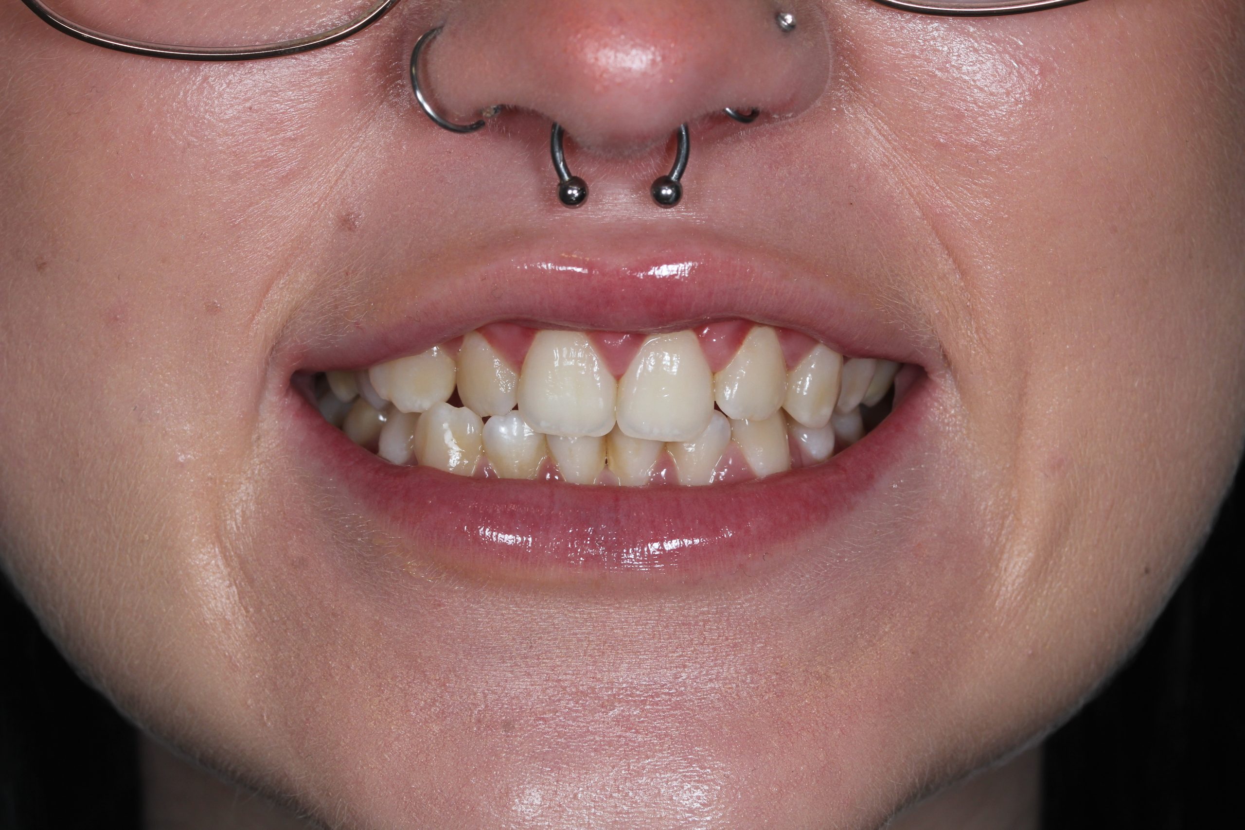 Invisalign before treatment