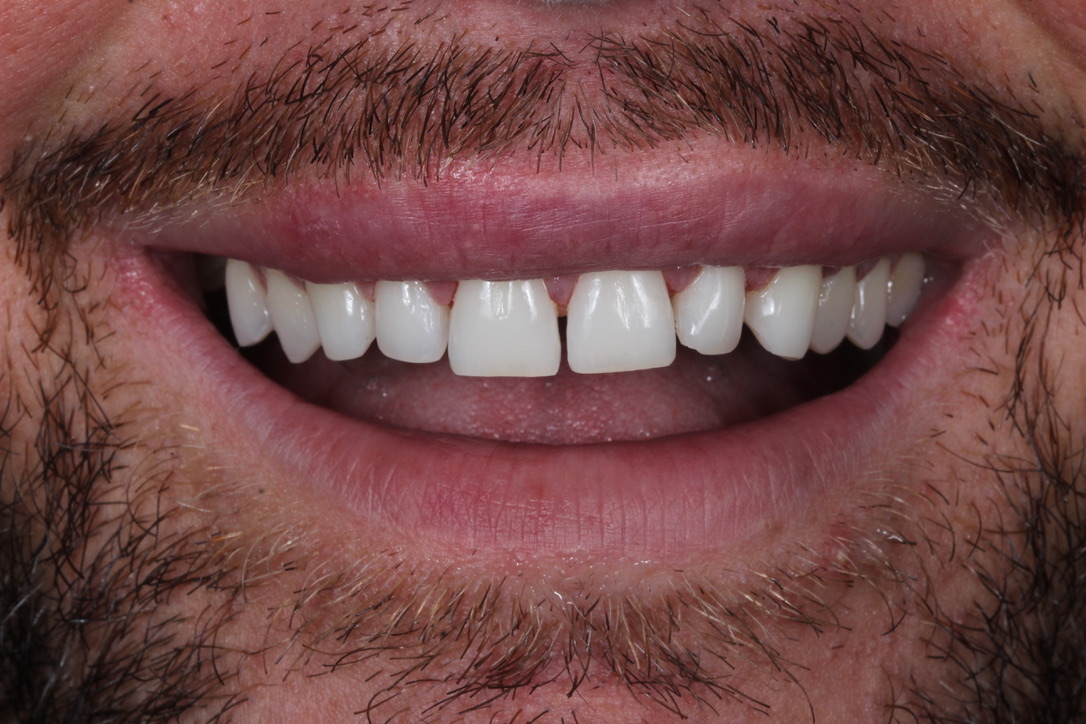 Veneers patient before treatment
