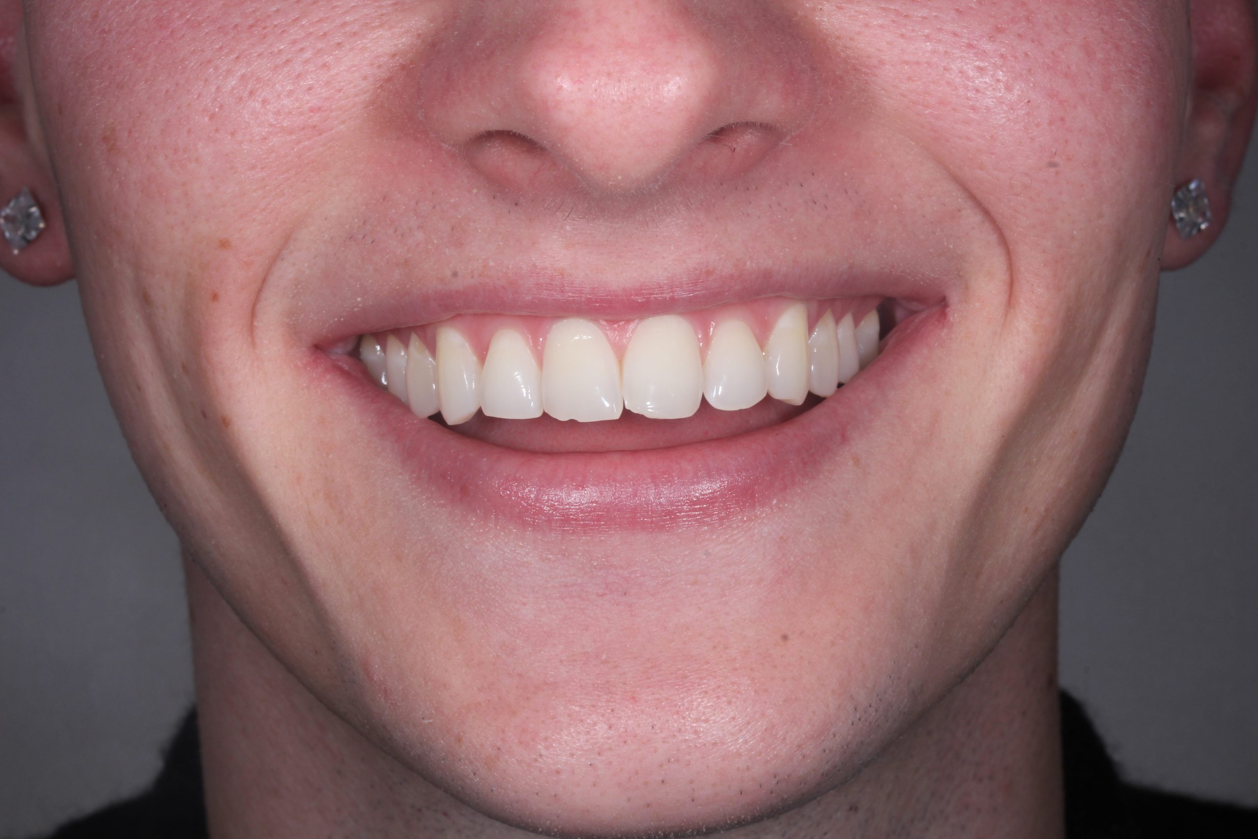 Composite bonding before treatment