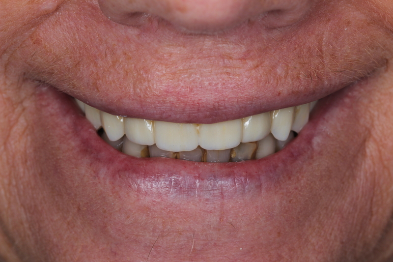 Dental implant after treatment