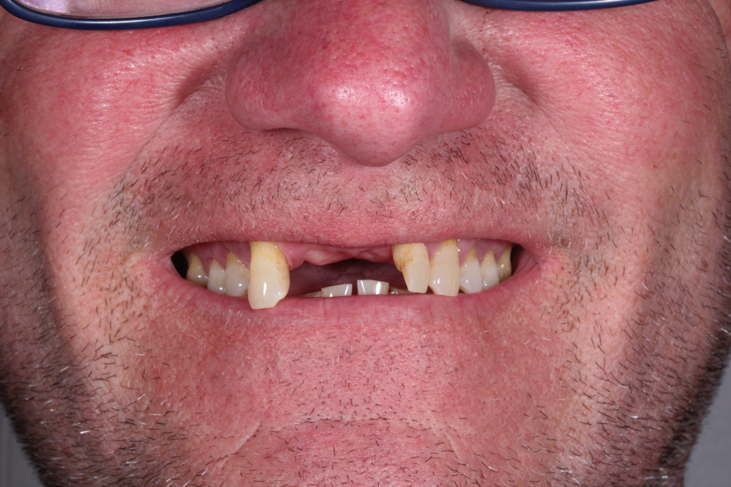 Dental implant before treatment