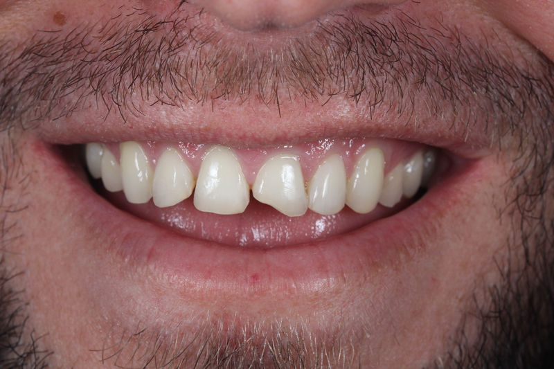 Composite bonding before treatment