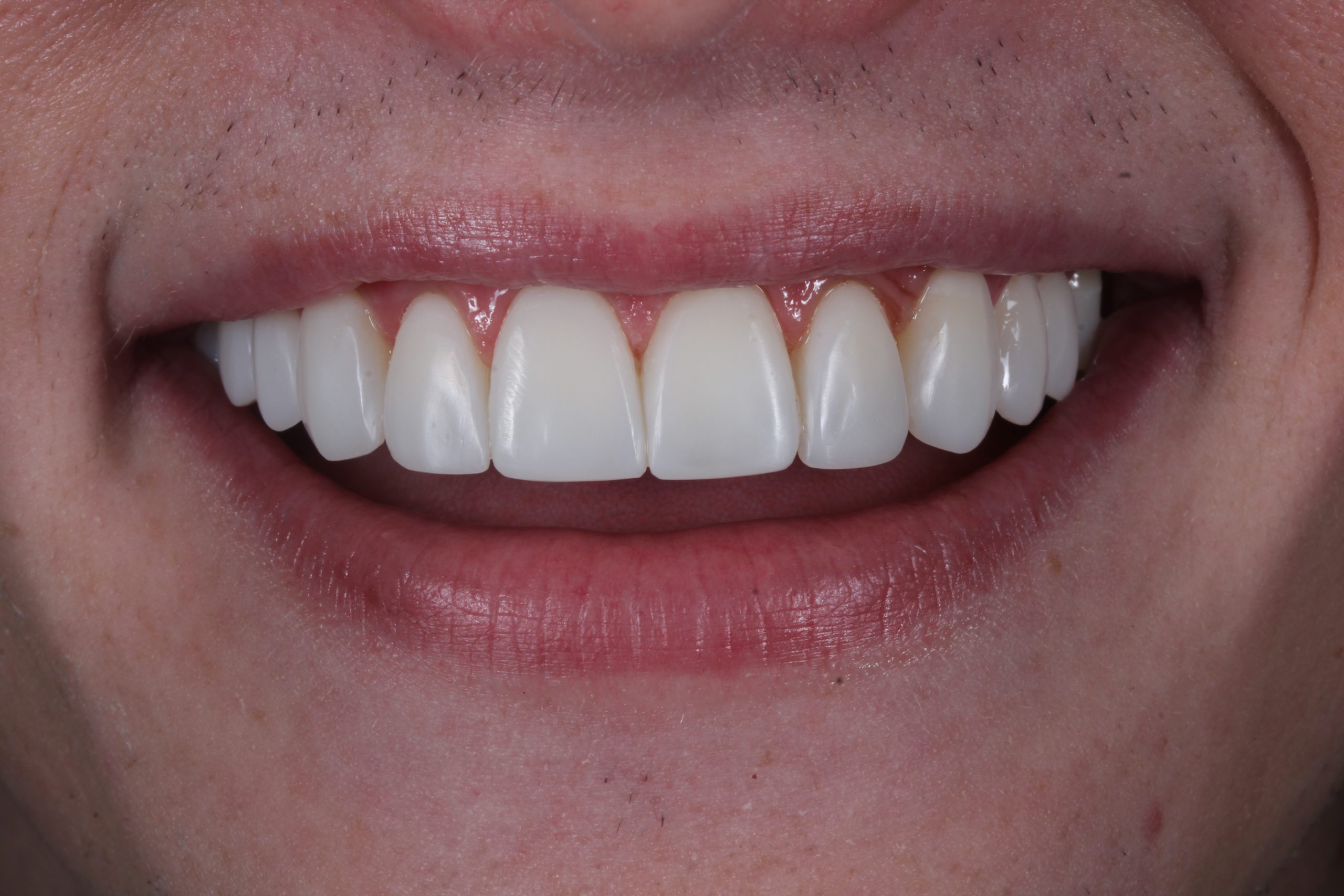 Composite bonding after treatment