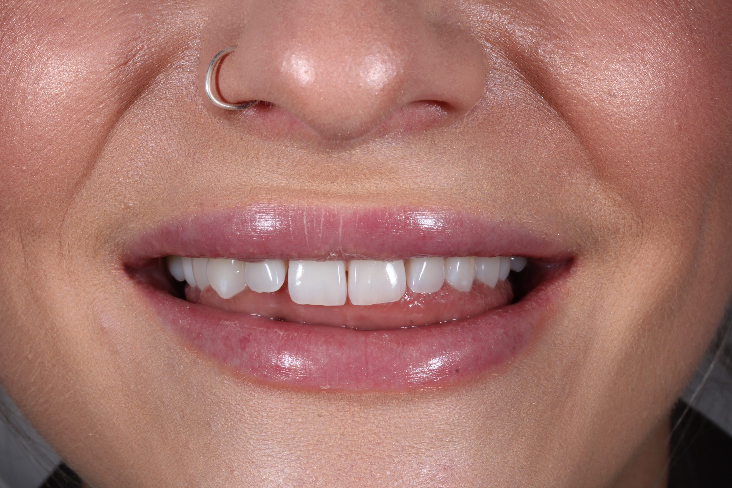Composite bonding patient before treatment