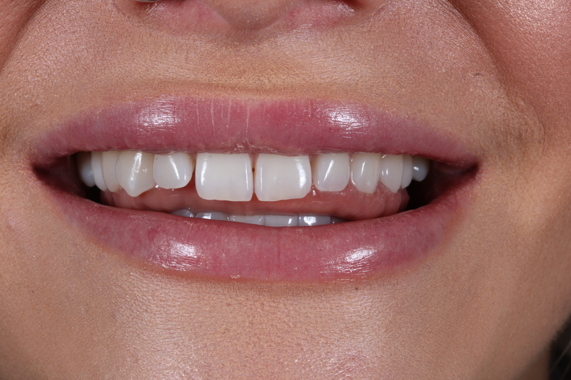 Composite bonding before treatment