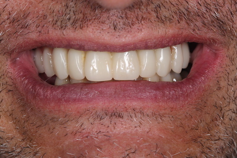 Dental implant after treatment