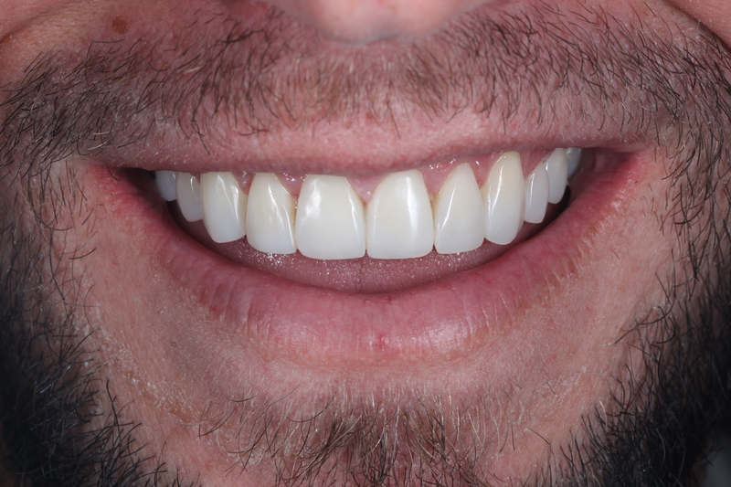Composite bonding after treatment