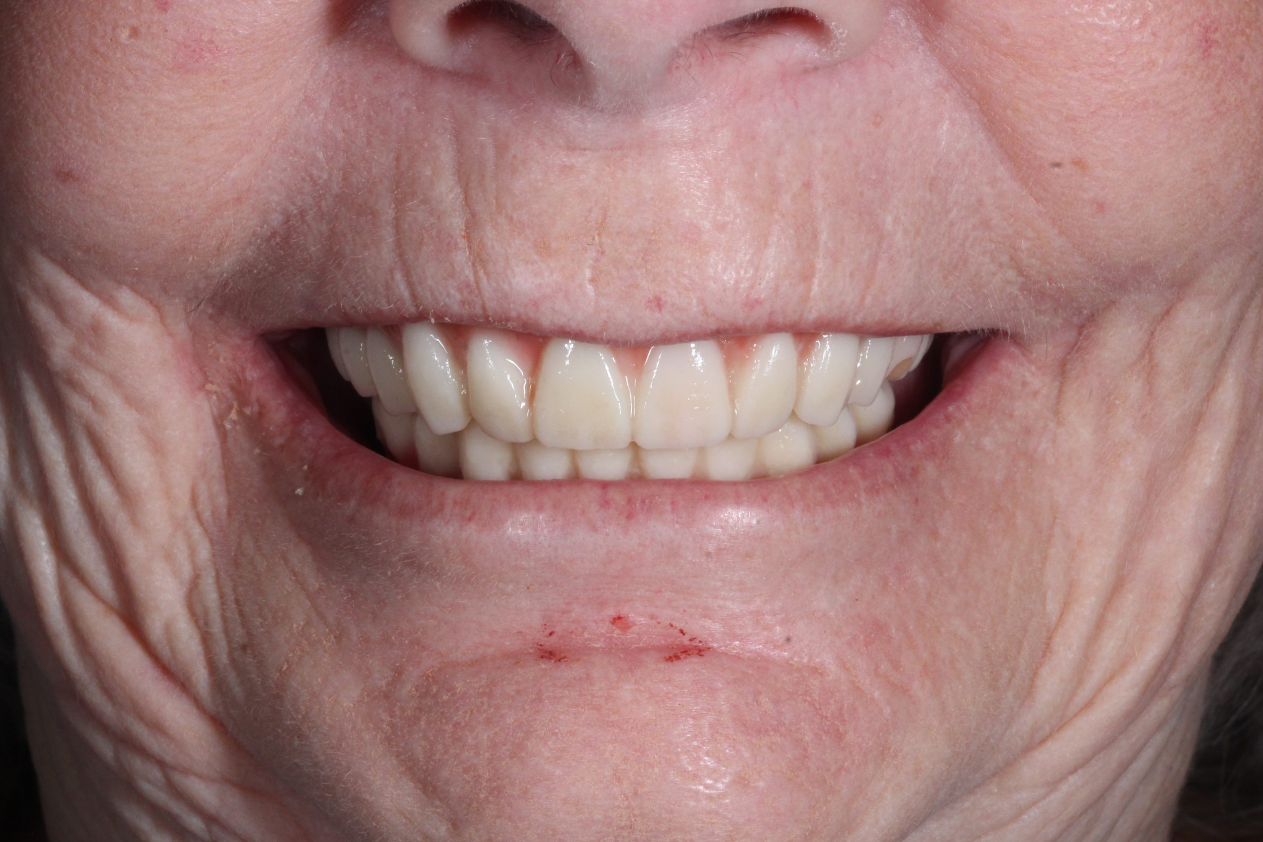 Dental implant after treatment