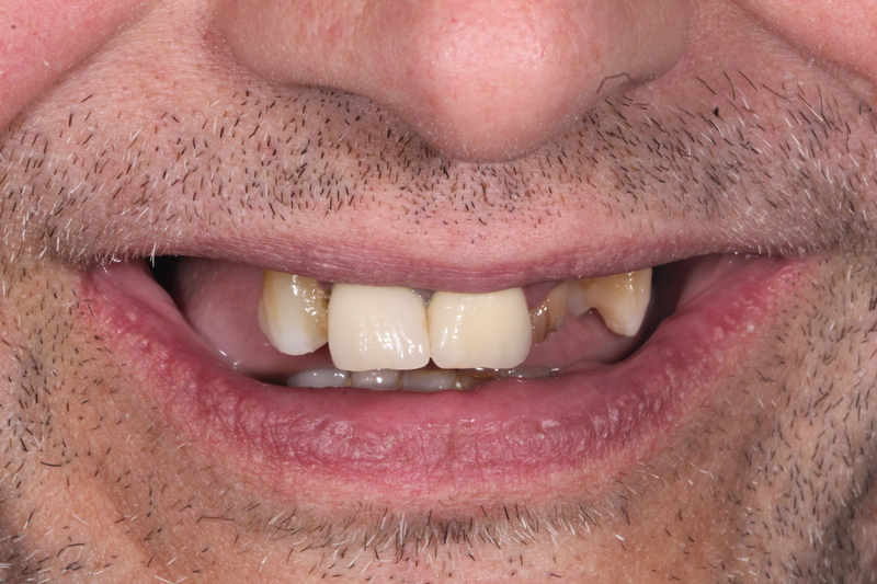 Dental implant before treatment