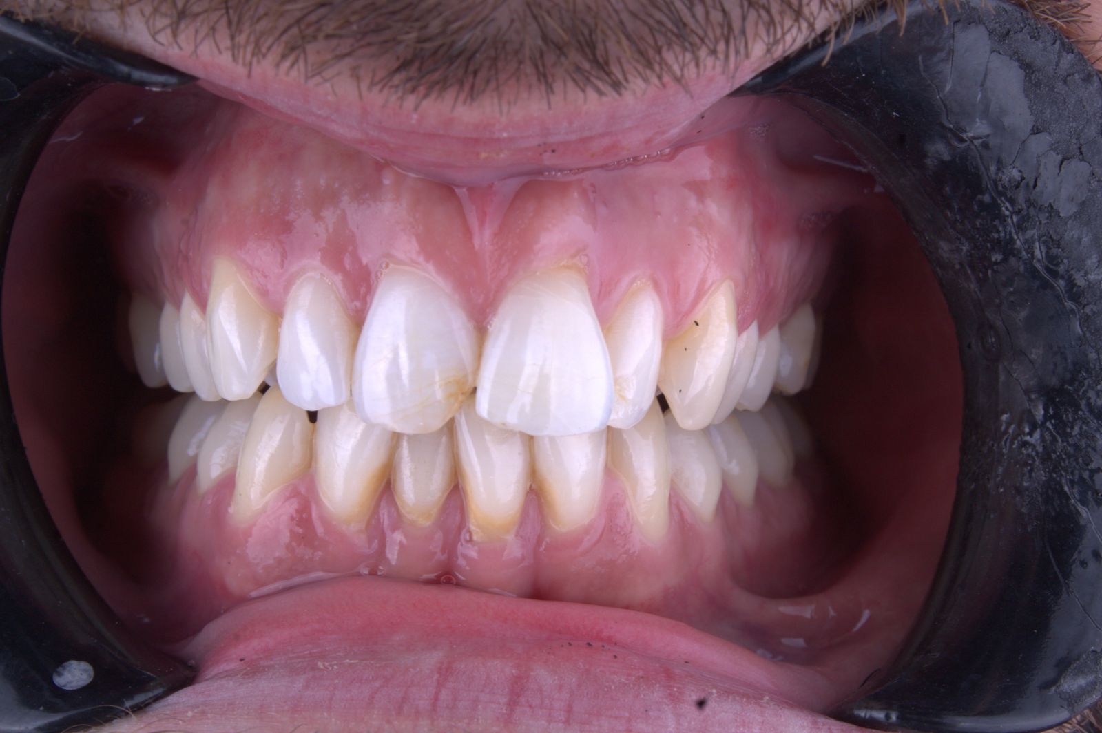 Teeth whitening after treatment