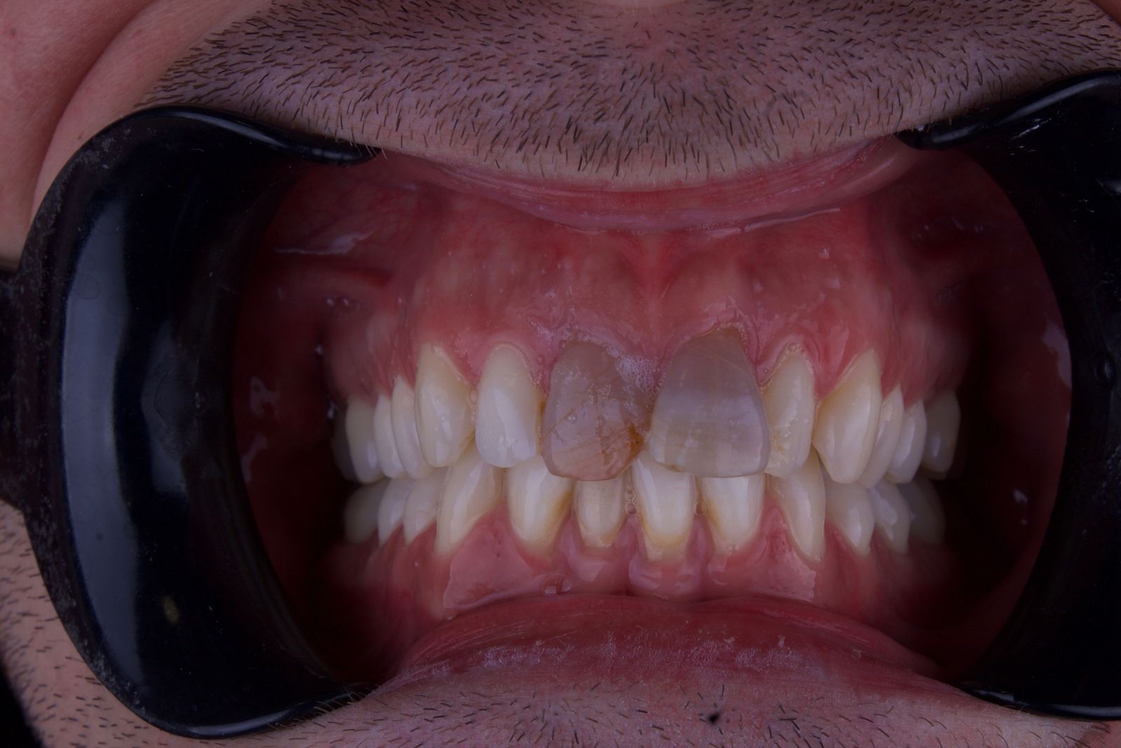 Teeth whitening before treatment