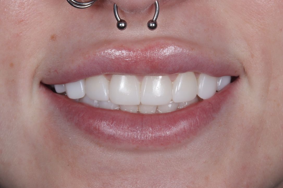 Invisalign patient finished with composite edge bonding