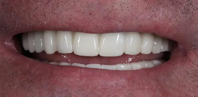 Dental implant after treatment