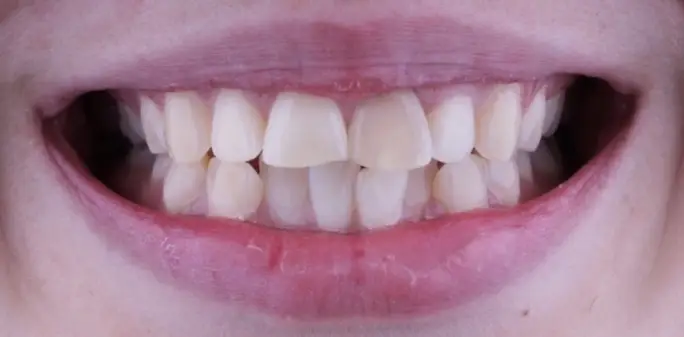 Teeth whitening after treatment
